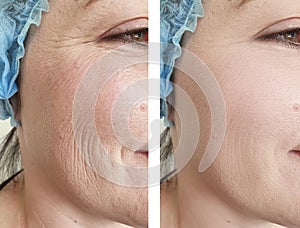 Woman wrinkles face  difference before and after treatments