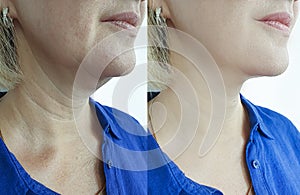 Woman wrinkles face before  facelift collage after treatments procedure problem