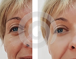 Woman wrinkles face before after health regeneration result treatment cosmetic procedures