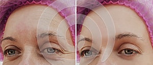 Woman wrinkles face before and after health regeneration result treatment cosmetic procedures