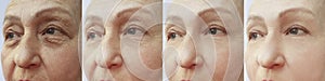 Woman wrinkles face before and after lifting  difference  tension therapy correction