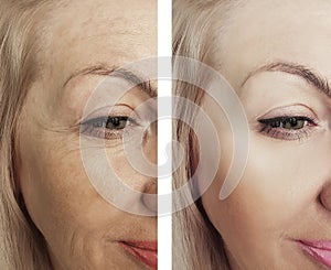 Woman wrinkles face before after mature results lifting therapy treatments