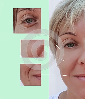 Woman wrinkles on face before and after patient injection anti-aging procedures