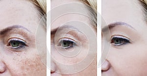 Woman wrinkles on face, pigmentation removal dermatology before and after procedures