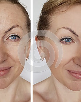 Woman wrinkles face before and after procedures