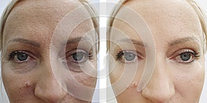 Woman wrinkles face before and after removal bags, bloating treatment difference correction mature procedures,