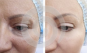 Woman wrinkles face before and after removal bags, bloating treatment difference correction procedures,