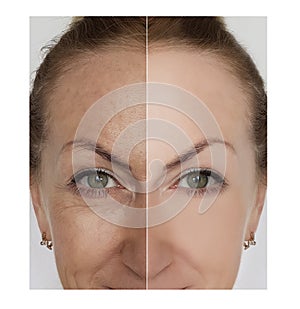 Woman wrinkles face before and after removal cosmetic procedures
