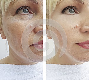 Woman wrinkles face before and after removal treatment difference correction procedures, oval