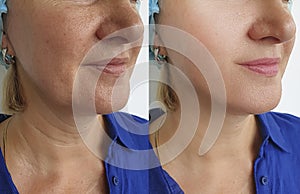 Woman wrinkles face before removal after treatment, double chin