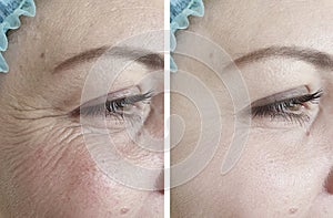 Woman wrinkles face result aging regeneration dermatology therapy removal rejuvenation before and after beautician correction