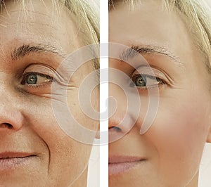 Woman wrinkles face before and after result treatment cosmetic procedures