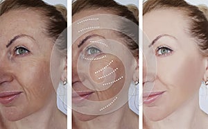 Woman wrinkles face before results difference after regeneration treatments rejuvenation