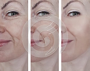 Woman wrinkles face before results medicine difference after regeneration treatments rejuvenation