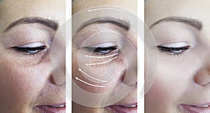 Woman wrinkles face rejuvenation arrow beautician ollage fect before and after treatments