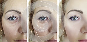 Woman wrinkles face rejuvenation arrow collage fect before and after treatments