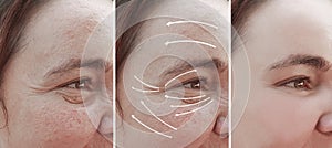 Woman wrinkles face rosacea before and after effect difference cosmetology therapy correction, arrow