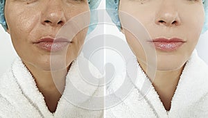 Woman wrinkles face sagging before and after effect  therapy  treatments