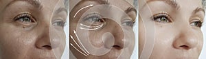 Woman wrinkles face skin after rejuvenation effect plastic therapy procedure treatment arrow thread lifting,