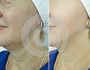 Woman wrinkles face swollen removal before treatment difference sagging correction