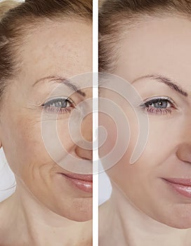 Woman wrinkles face before and after therapy removal cosmetic procedures