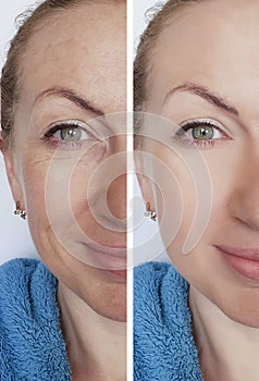 Woman wrinkles face before and after therapy removal cosmetic procedures difference