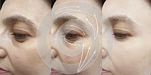 Woman wrinkles face before  after cosmetology  correction effect plastic therapy procedure treatment arrow thread lifting,