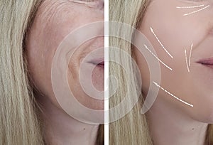 Woman wrinkles face treatment before and after correction dermatology procedures regeneration