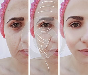 Woman wrinkles on face, treatment effect correction contrast before and after procedures, arrow