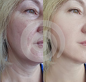 Woman wrinkles face before result correction mature plastic facelift collage after treatments procedure problem photo