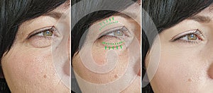 Woman wrinkles face swollen removal blepharoplasty therapy contrast before treatment difference sagging correction photo