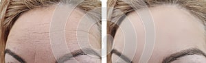 Woman wrinkles before and after forehead treatment biorevitalization