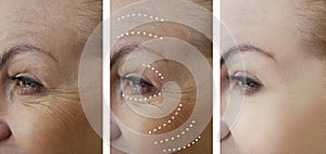 Woman wrinkles lifting before after difference correction regeneration cosmetology treatments