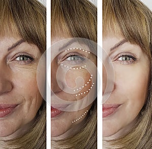 Woman wrinkles lifting hyaluronic before after difference correction regeneration cosmetology treatments