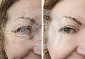 woman wrinkles mature correction results contrast before and after procedures
