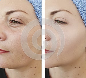 Woman wrinkles before and after mature filler treatments