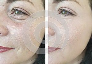 Woman wrinkles before and after mature treatments