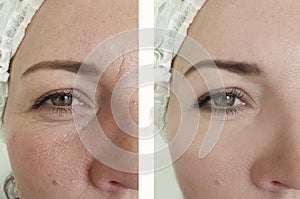 Woman wrinkles before after oval effect mature  cosmetology difference lift antiaging procedures