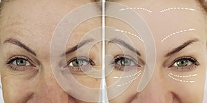 Woman wrinkles before patient skin results lifting after regeneration results medicine procedures, facial