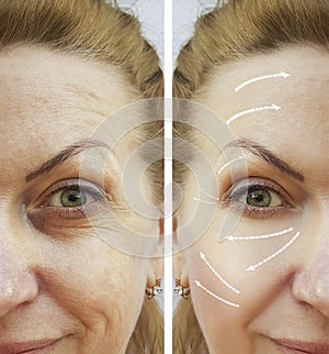 woman wrinkles before and after procedures