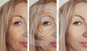 Woman wrinkles before and after procedures, arrow