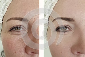 Woman wrinkles before after oval effect mature  cosmetology difference lift antiaging procedures photo