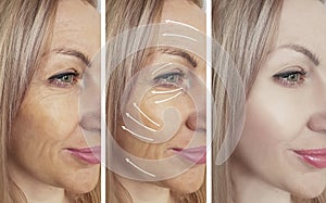 Woman wrinkles before and after procedures, tightening rrow