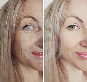 Woman wrinkles removal face biorevitalization before and after treatments