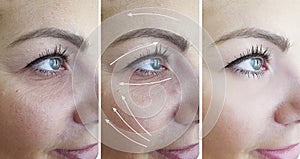 Woman wrinkles removal face before eye filler rejuvenation collage treatments