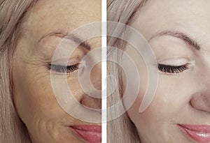Woman wrinkles removal face lifting biorevitalization before and after treatments