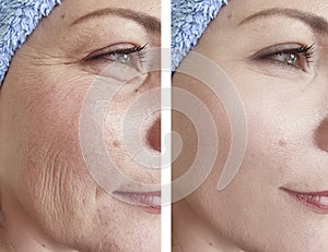 Woman wrinkles before and after result mature filler treatments