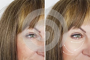 woman wrinkles before results beautician treatment lifting after regeneration results medicine procedures, facial