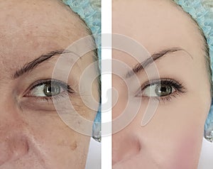 Woman wrinkles before after results removal correction cosmetology therapy, ageing procedure biorevitalization treatments