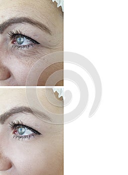 Woman wrinkles sagging lifting treatment rejuvenation tension before and after correction